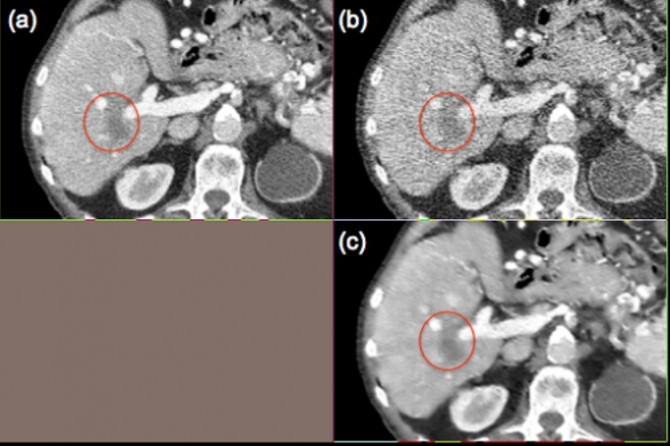 (a)정상 선량으로 촬영한 CT 영상. 붉은 원은 종양 부분을 나타낸다. (b) 저선량으로 촬영한 CT 영상. (c) 저선량 영상에 딥러닝을 적용한 결과 영상 왜곡을 효과적으로 제거하고 화질을 개선해 종양부분이 정확히 나타났다. - KAIST 제공